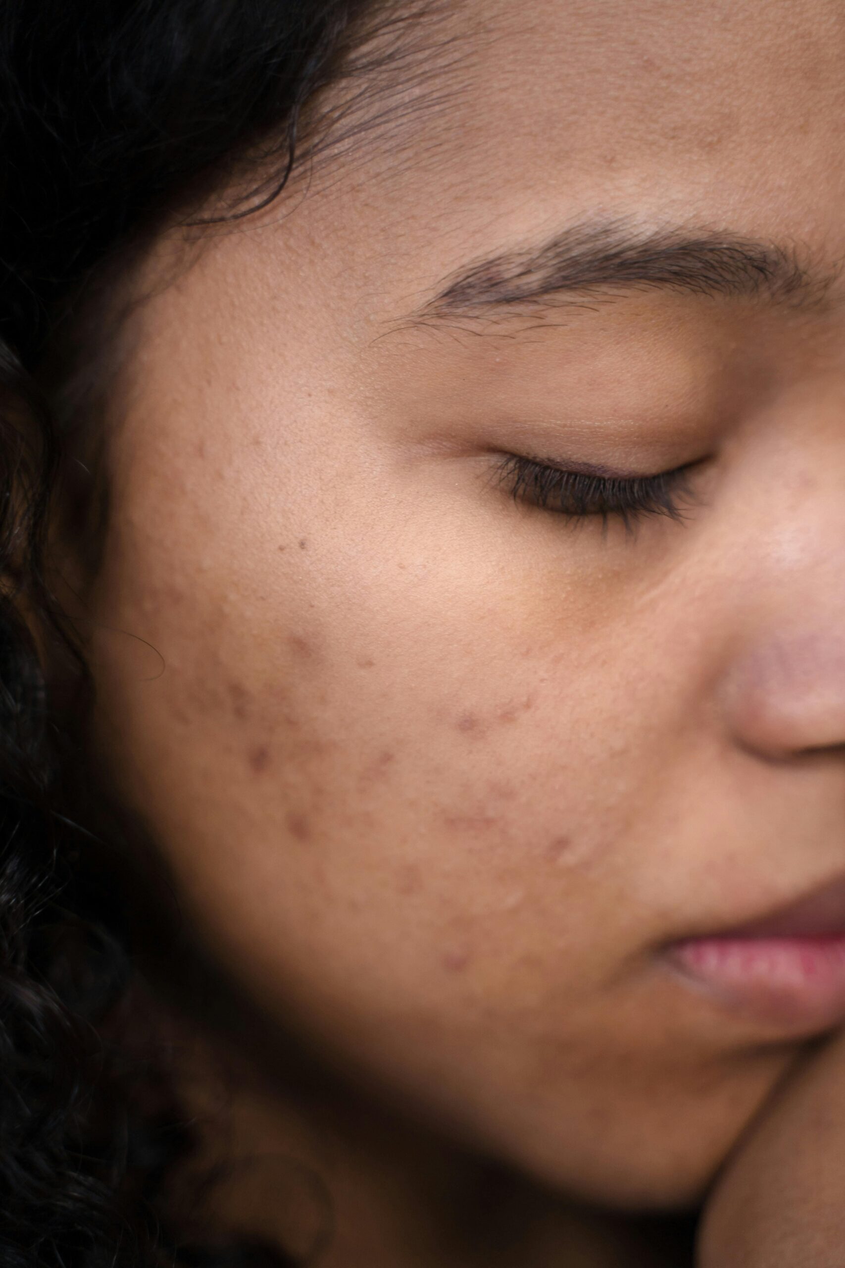 Acne e autoestima menina jovem