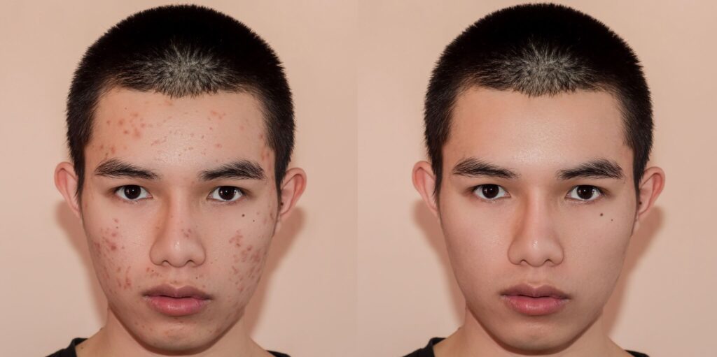 Acne tratamento antes e depois